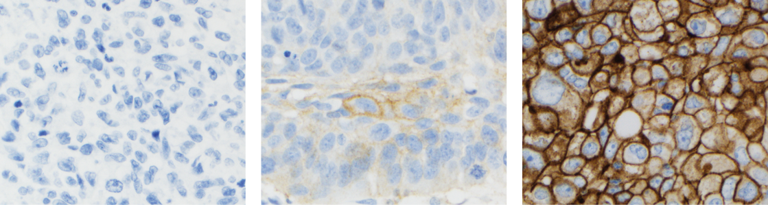 PD-L1 IHC 22C3 pharmDx delivers high sensitivity